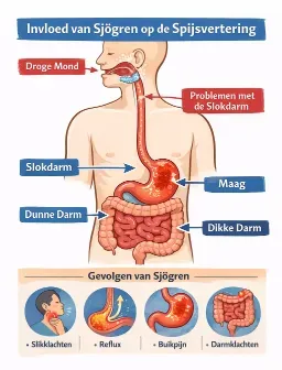 invloed van sjogren op spijsvertering
